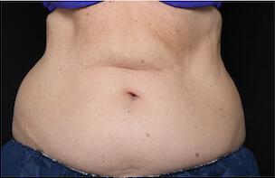 Fat Reduction Gallery Before & After Image