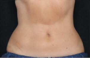 Fat Reduction Gallery Before & After Image