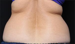 Fat Reduction Gallery Before & After Image