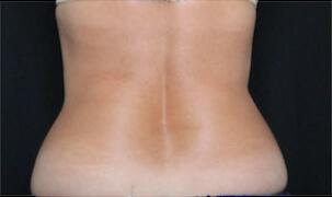 Fat Reduction Gallery Before & After Image