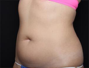 Fat Reduction Gallery Before & After Image