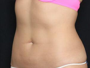 Fat Reduction Gallery Before & After Image