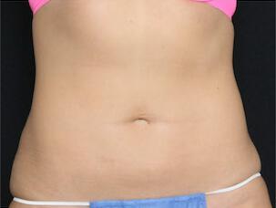 Fat Reduction Gallery Before & After Image