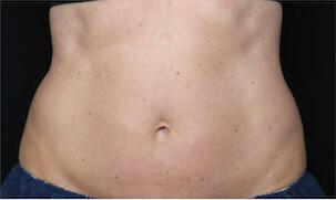 Fat Reduction Gallery Before & After Image