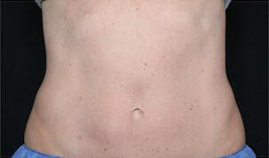 Fat Reduction Gallery Before & After Image