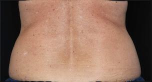 Fat Reduction Gallery Before & After Image