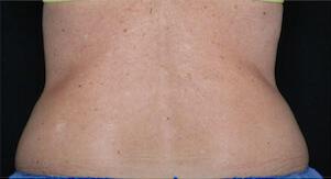 Fat Reduction Gallery Before & After Image