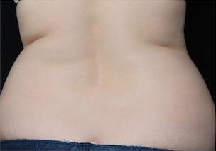 Fat Reduction Gallery Before & After Image