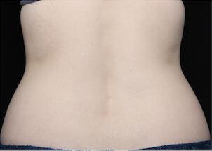 Fat Reduction Gallery Before & After Image