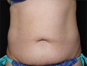 Fat Reduction Gallery Before & After Image