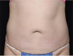 Fat Reduction Gallery Before & After Image