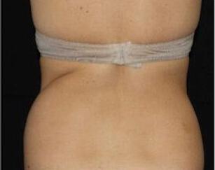 Fat Reduction Gallery Before & After Image