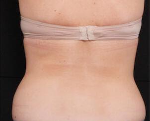 Fat Reduction Gallery Before & After Image