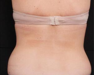 Fat Reduction Gallery Before & After Image