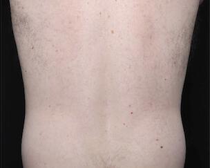 Fat Reduction Gallery Before & After Image