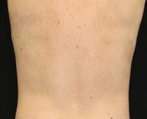 Fat Reduction Gallery Before & After Image