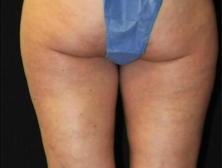 Fat Reduction Gallery Before & After Image