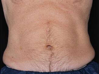 Fat Reduction Gallery Before & After Image