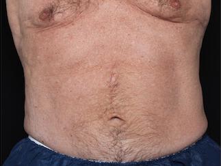 Fat Reduction Gallery Before & After Image