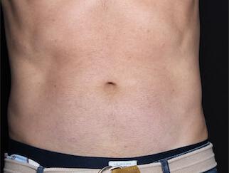 Fat Reduction Gallery Before & After Image