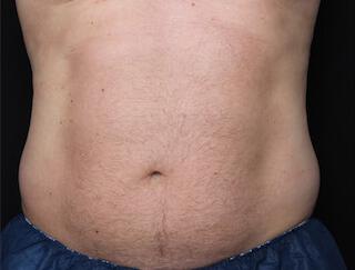 Fat Reduction Gallery Before & After Image