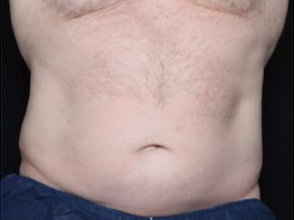 Fat Reduction Gallery Before & After Image