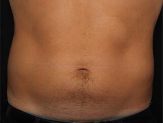 Fat Reduction Gallery Before & After Image