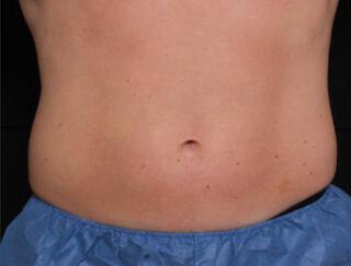 Fat Reduction Gallery Before & After Image