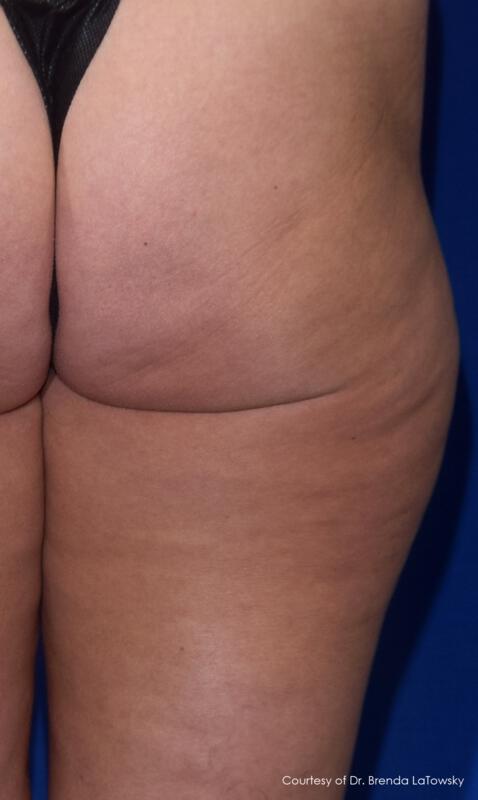 Resonic Celulite Reduction Gallery Before & After Image