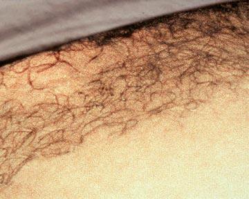 Laser Hair Removal Gallery Before & After Image