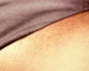 Laser Hair Removal Gallery Before & After Image