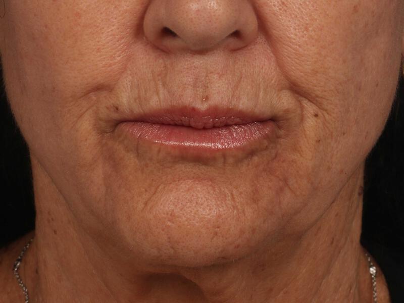 BOTOX® Cosmetic Gallery Before & After Image