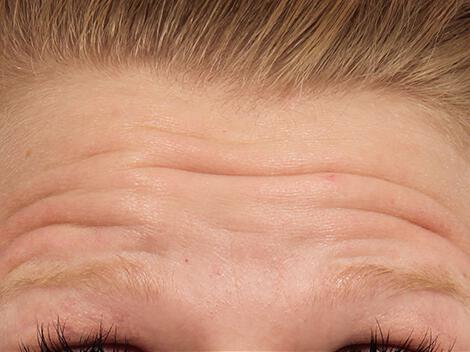 BOTOX® Cosmetic Gallery Before & After Image