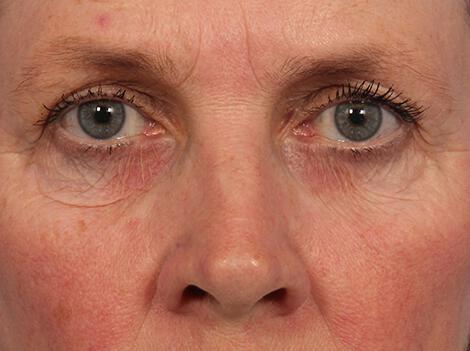 BOTOX® Cosmetic Gallery Before & After Image