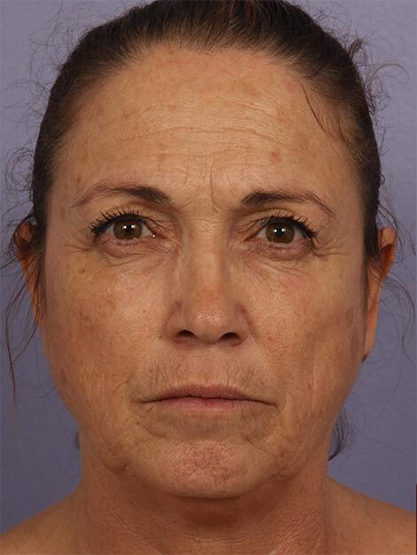 BOTOX® Cosmetic Gallery Before & After Image