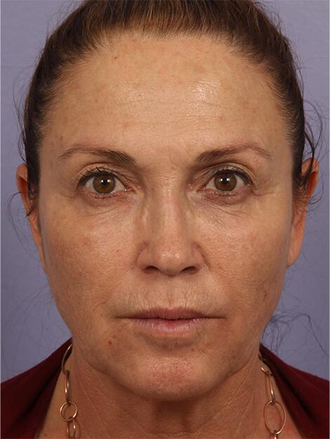 BOTOX® Cosmetic Gallery Before & After Image