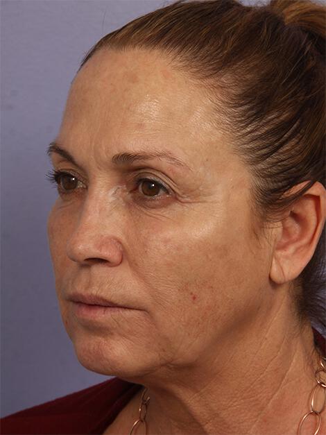 BOTOX® Cosmetic Gallery Before & After Image