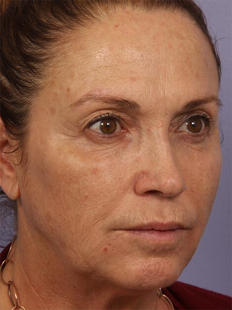 BOTOX® Cosmetic Gallery Before & After Image