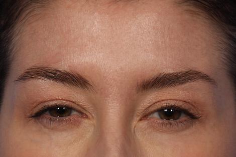 BOTOX® Cosmetic Gallery Before & After Image