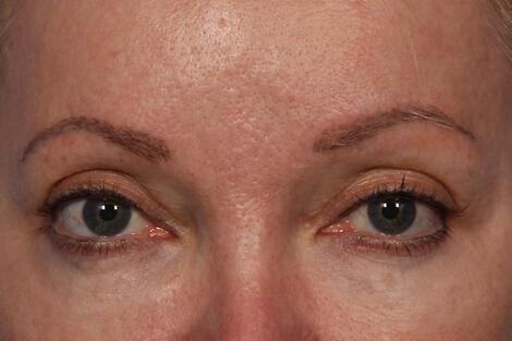 BOTOX® Cosmetic Gallery Before & After Image