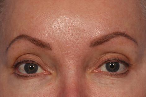 BOTOX® Cosmetic Gallery Before & After Image