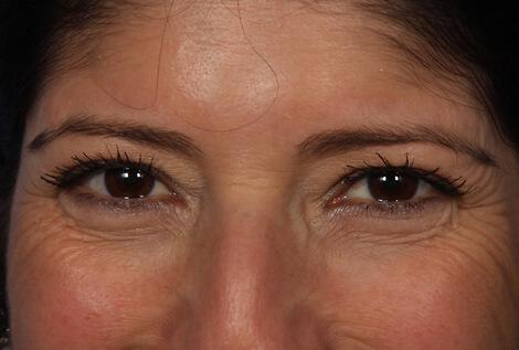 BOTOX® Cosmetic Gallery Before & After Image