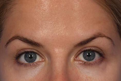 BOTOX® Cosmetic Gallery Before & After Image