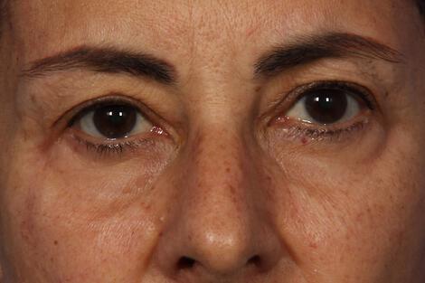 BOTOX® Cosmetic Gallery Before & After Image