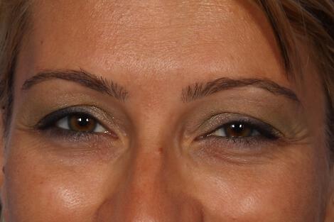 BOTOX® Cosmetic Gallery Before & After Image