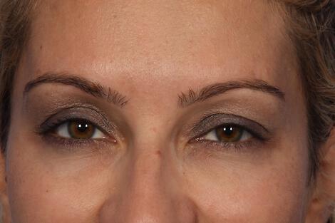 BOTOX® Cosmetic Gallery Before & After Image