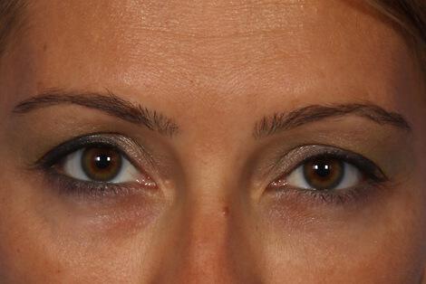 BOTOX® Cosmetic Gallery Before & After Image