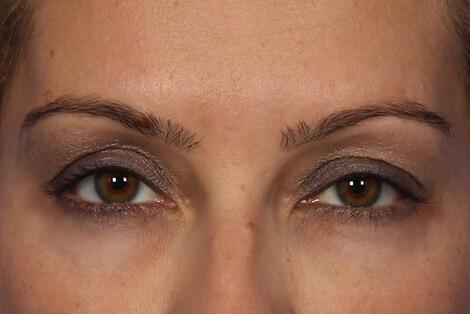 BOTOX® Cosmetic Gallery Before & After Image