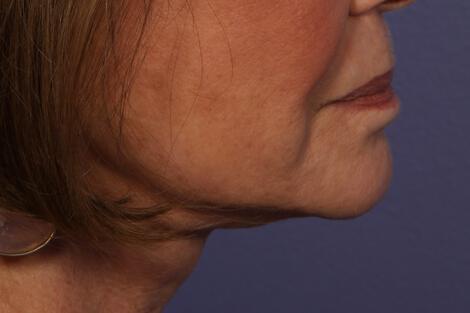 BOTOX® Cosmetic Gallery Before & After Image