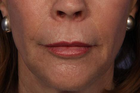 BOTOX® Cosmetic Gallery Before & After Image